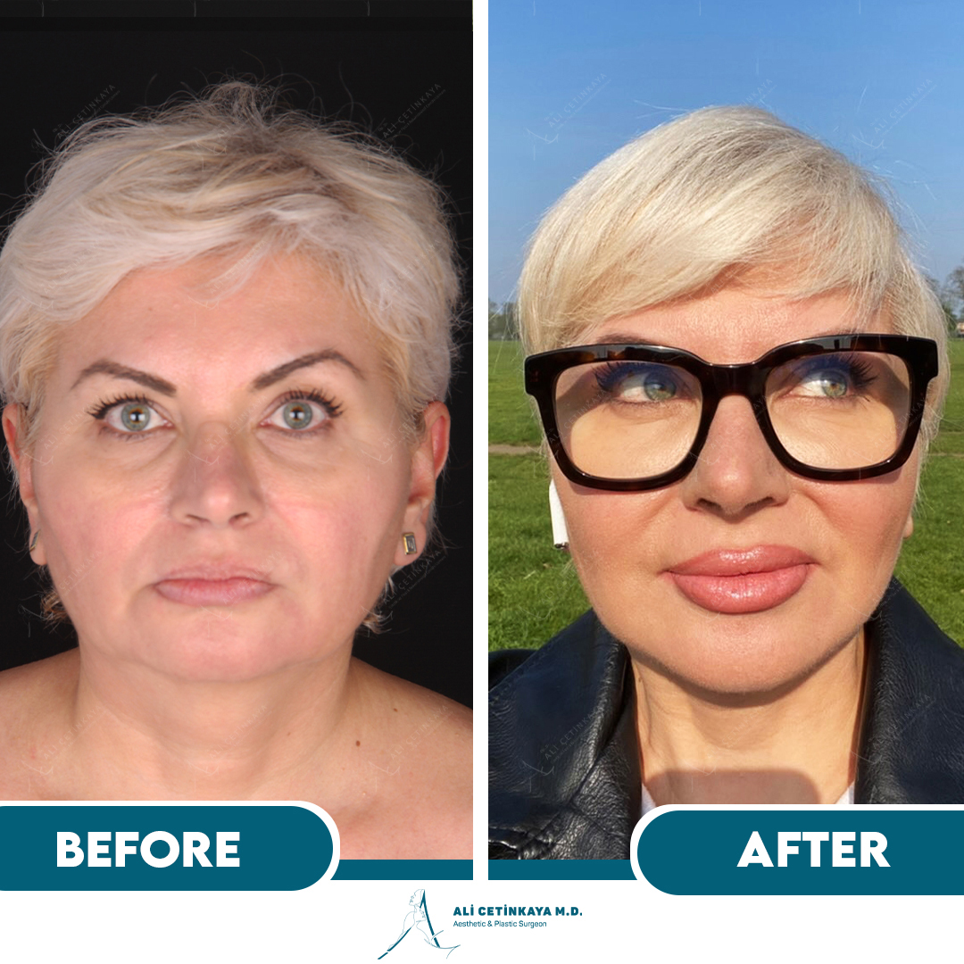 Facelift before and after results