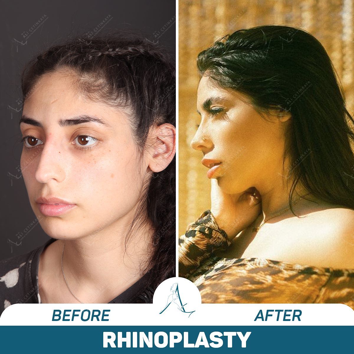 Rhinoplasty before and after results