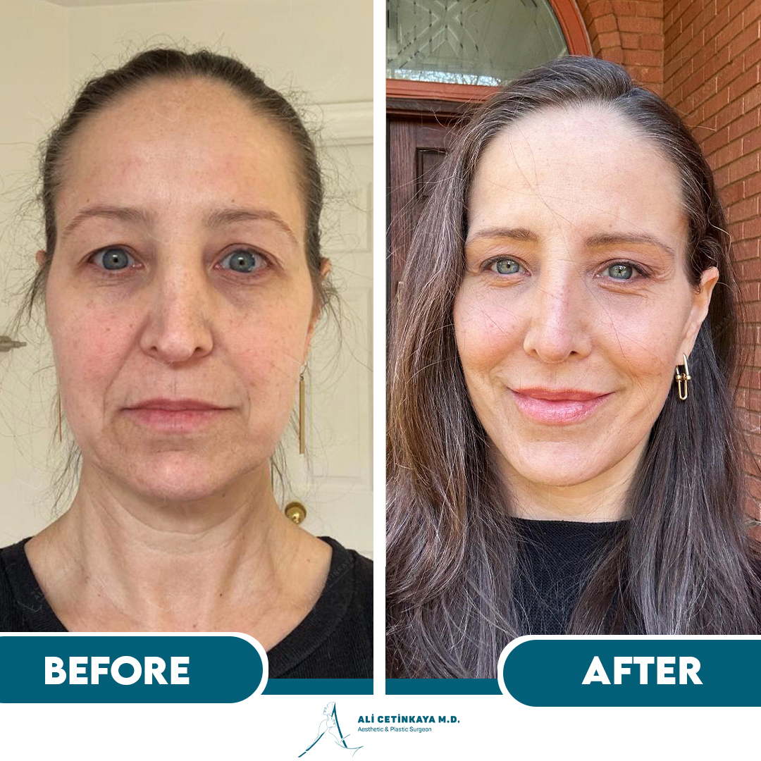 Deep plane facelift before and after - Patient 1