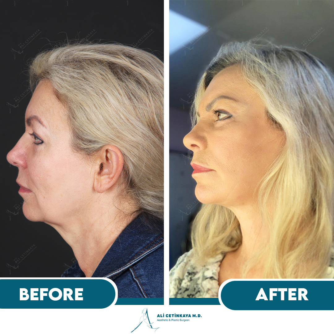 Deep plane facelift before and after - Patient 2