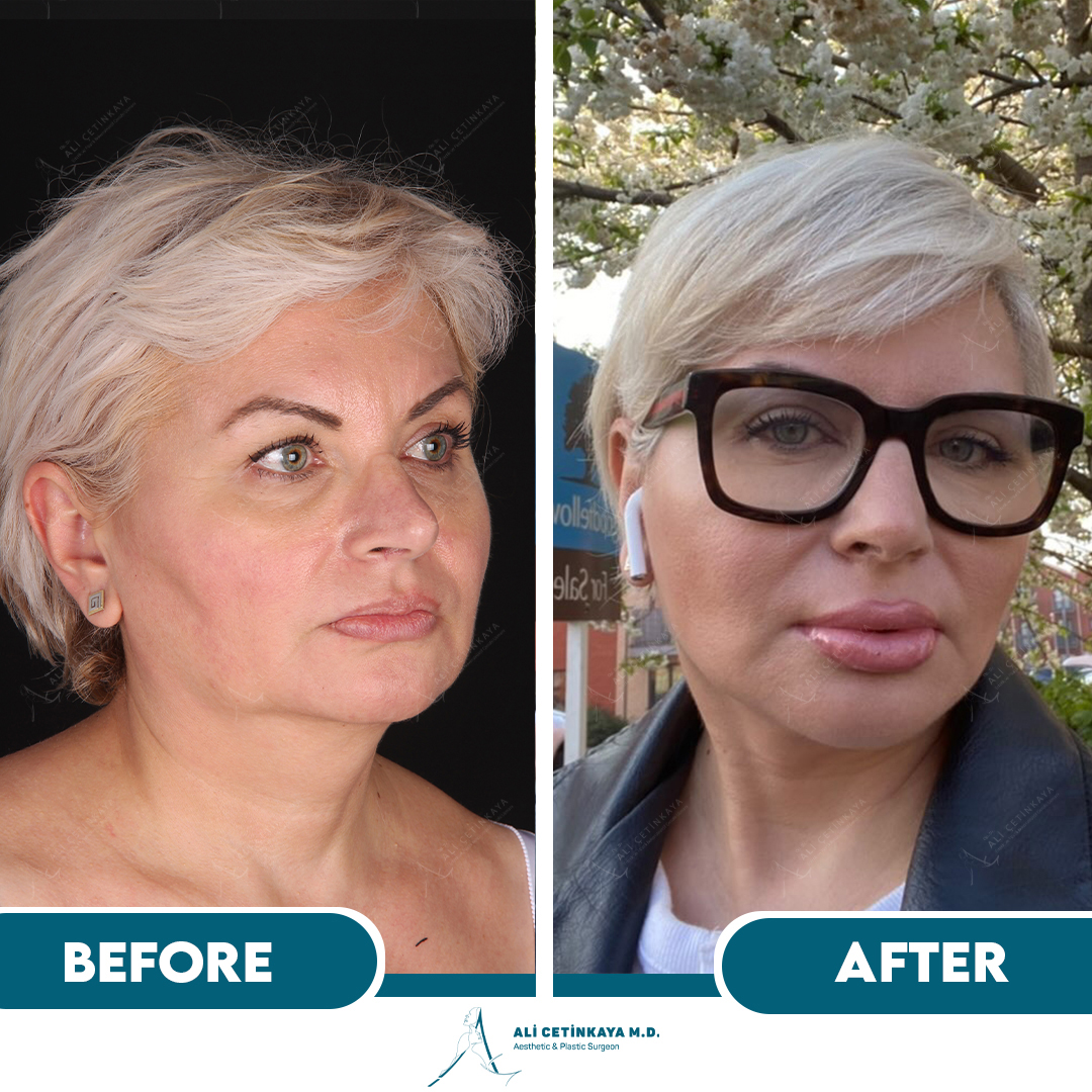 Deep plane facelift before and after - Patient 3