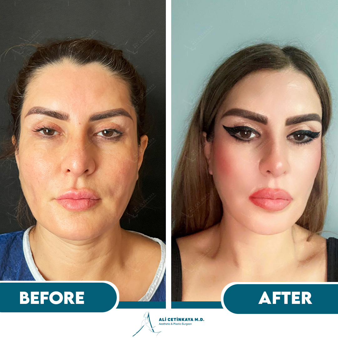 Facelift before and after - Patient 1