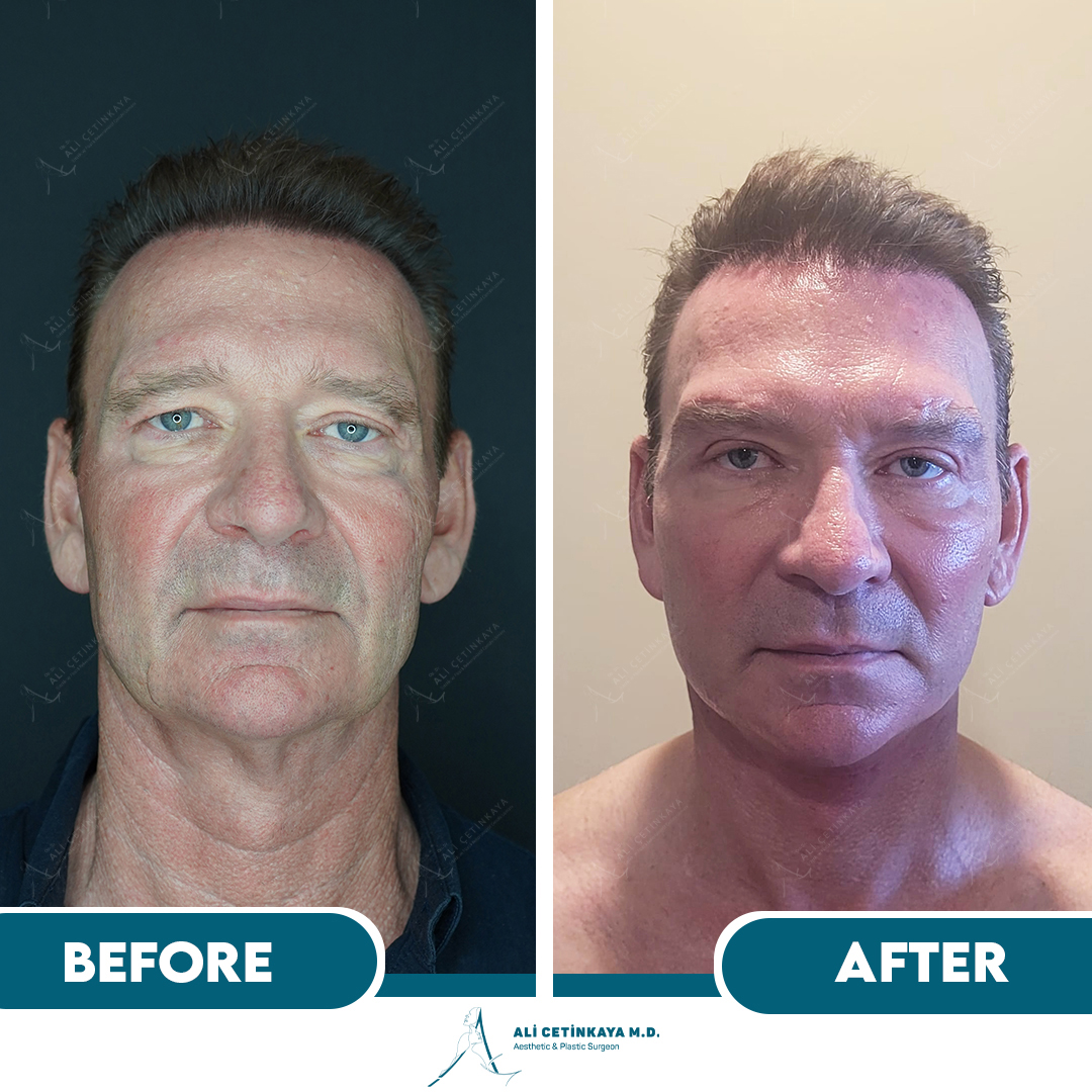 Facelift before and after - Patient 2