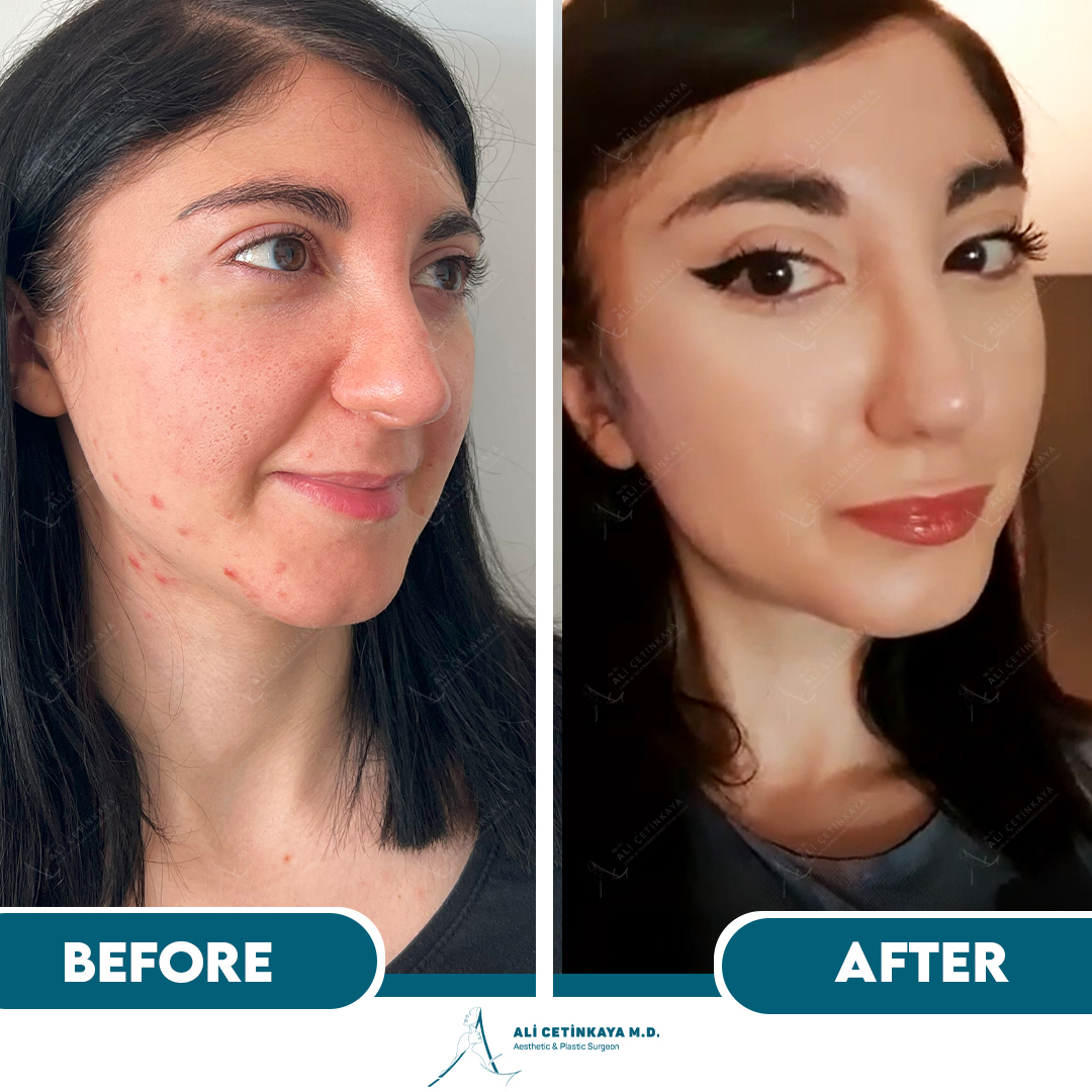 Facelift before and after - Patient 4