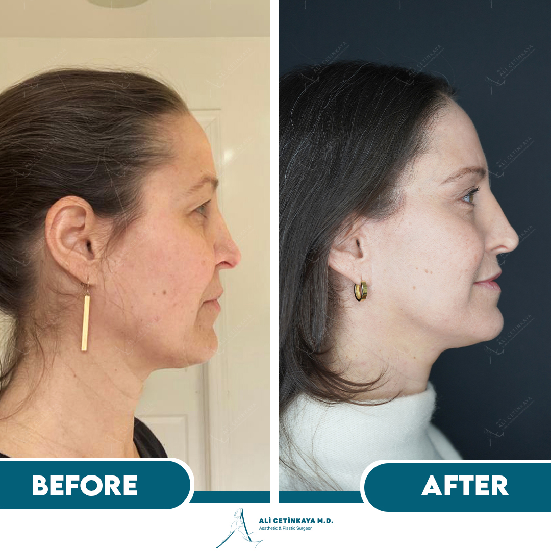 Facelift surgery consultation