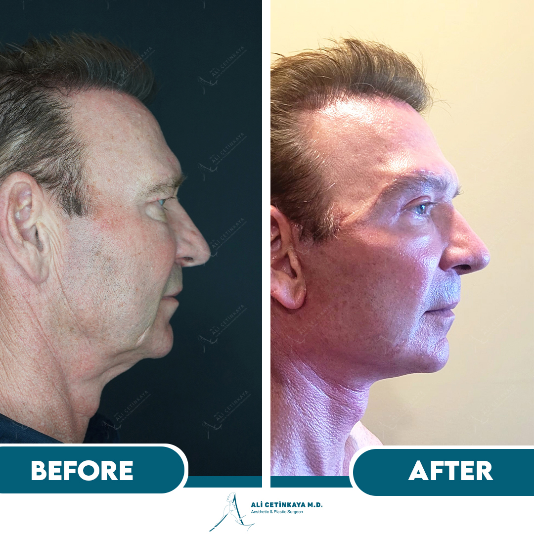 Facelift procedure explanation