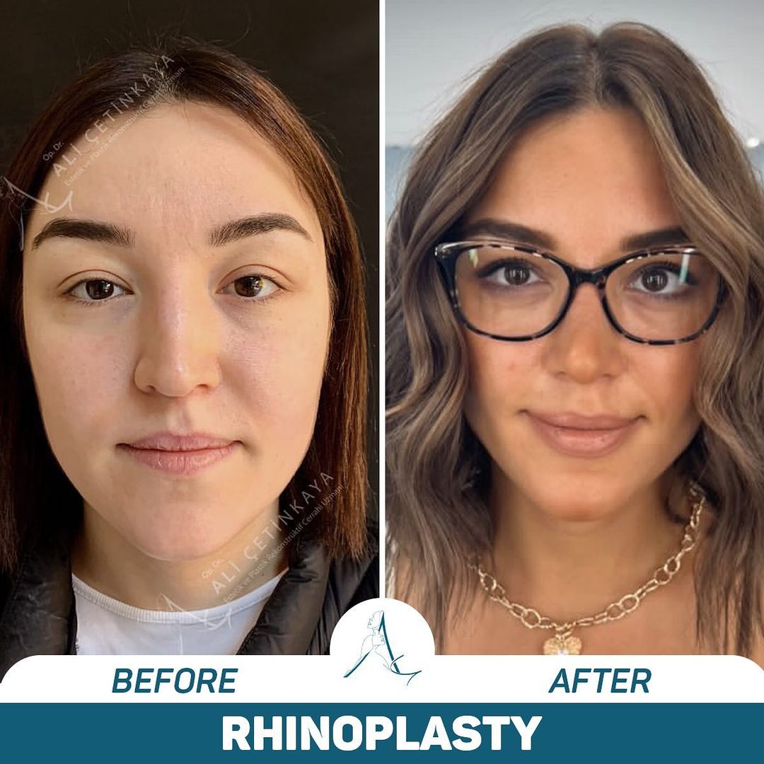Rhinoplasty before and after - Patient 2