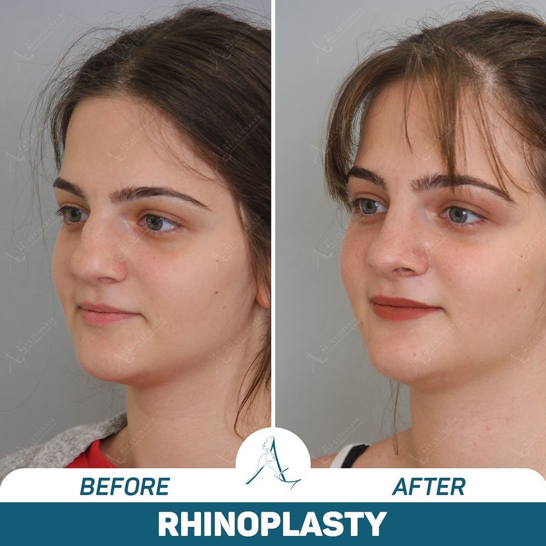 Rhinoplasty before and after - Patient 4