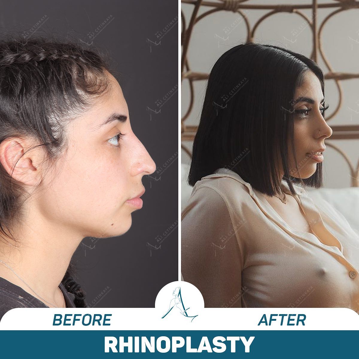Rhinoplasty surgery consultation