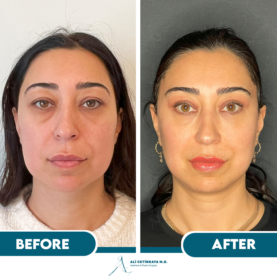 Temple lift before and after - Patient 1