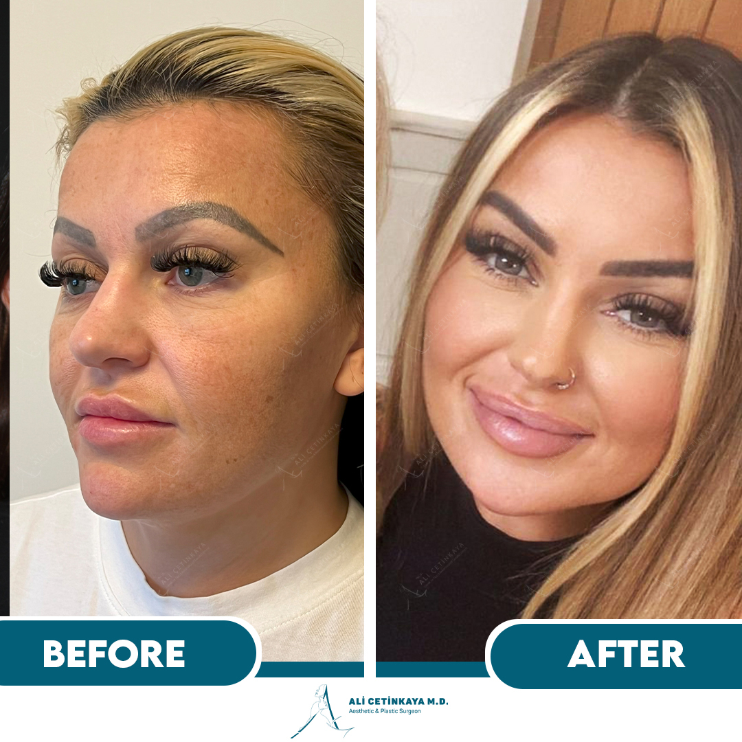 Temple lift before and after - Patient 4