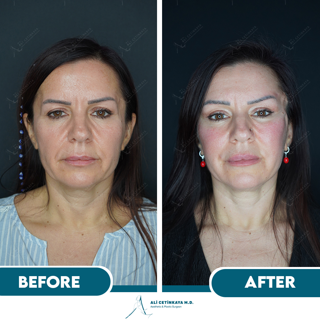 Temple lift procedure explanation